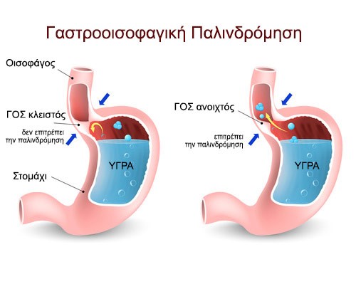 Συμπτώματα γαστροοισοφαγικής παλινδρόμησης